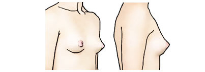 Женская грудь конической формы