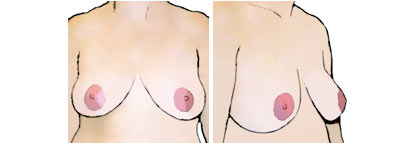 Женская грудь с низкой проекцией