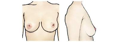 Классическая форма женской груди