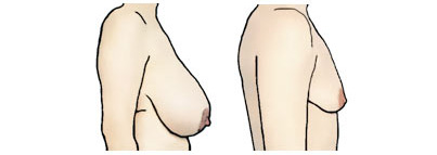 Рисунок обвисшей женской груди