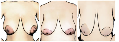 Рисунок изображающий большие ареолы на женской груди