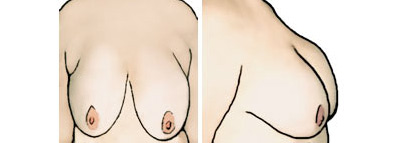 Рисунок женской груди со слишком объемной верхней частью