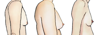 Изображение женской фигуры с искривлением позвоночника