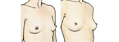 Варианты женской груди с выпирающими сосками