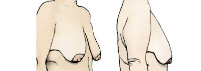 Рисунок женщины - складка кожи под рукой около грудной железы