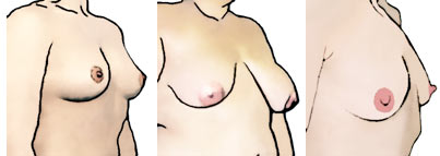 Рисунок женской фигуры с выступающей грудной костью